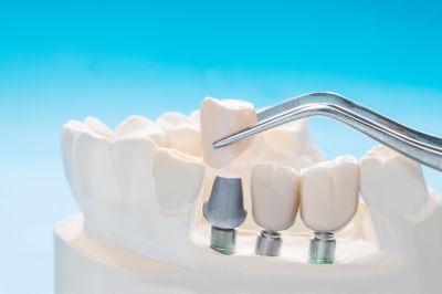 Dental Implant Crowns